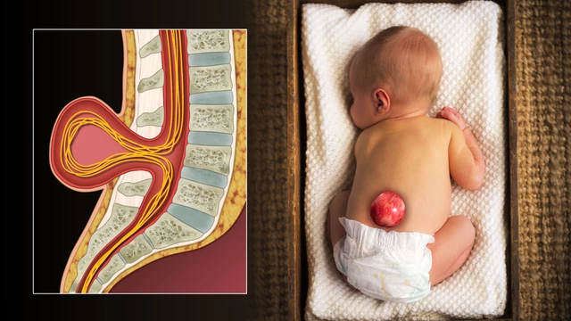 Pediatric Neural Tube Defect Surgery