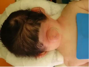 Pediatric Occipital Encephalocele Repair Surgery