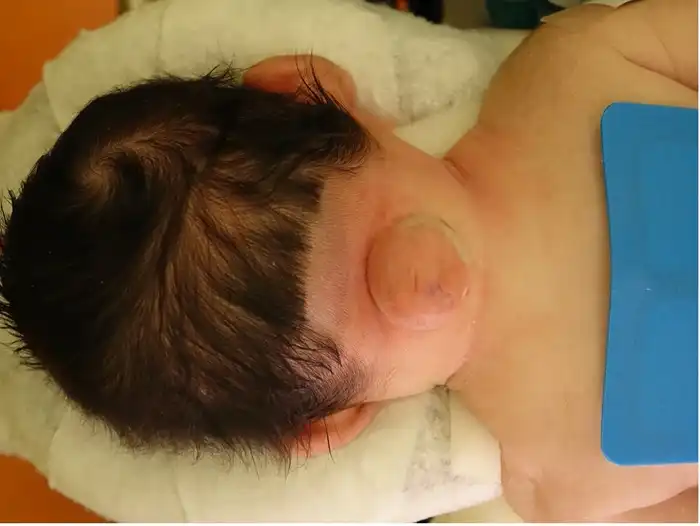 Pediatric Occipital Encephalocele Repair Surgery