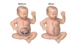 Pediatric Omphalocele Repair Surgery