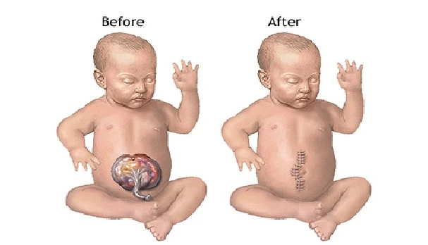 Pediatric Omphalocele Repair Surgery