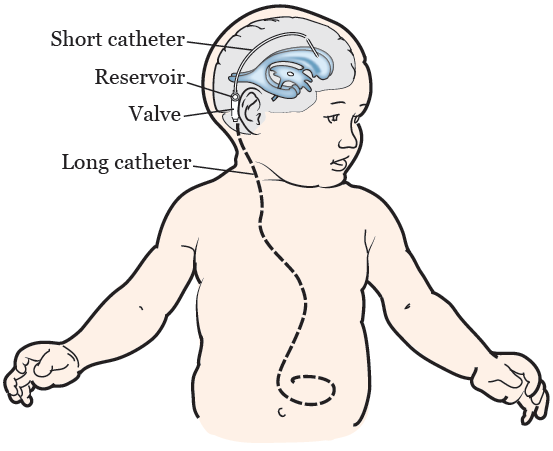 Pediatric VP Shunt (Hydrocephalus) Surgery
