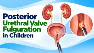 Posterior Urethral Valve Fulguration in Children