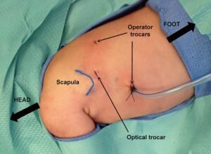 Thoracoscopic CDH Repair in Children