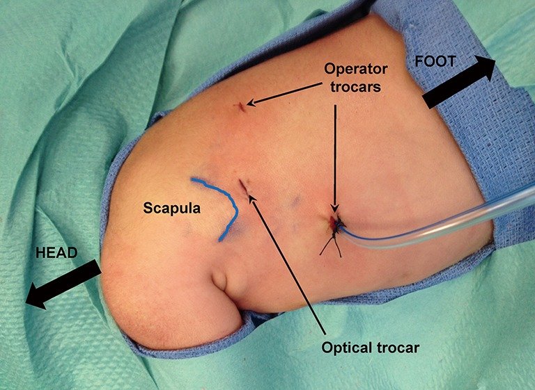 Thoracoscopic CDH Repair in Children