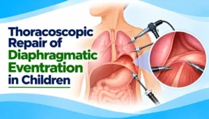 Thoracoscopic Repair of Diaphragmatic Eventration in Children