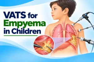 VATS for Empyema in Children